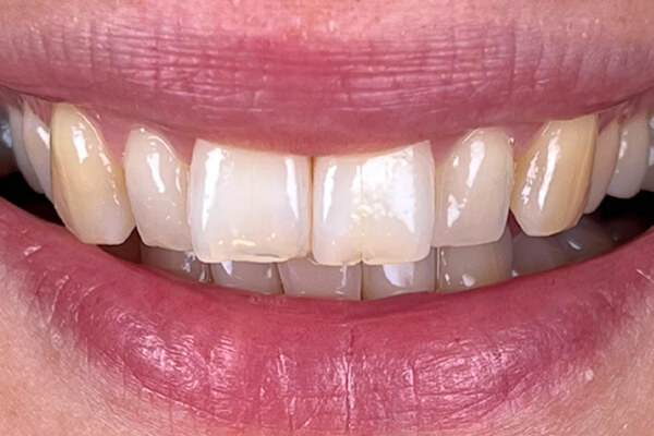 Estetinis 1 — before