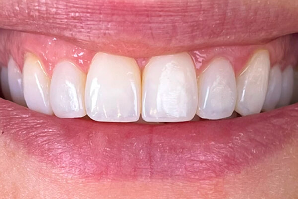 Estetinis 1 — after