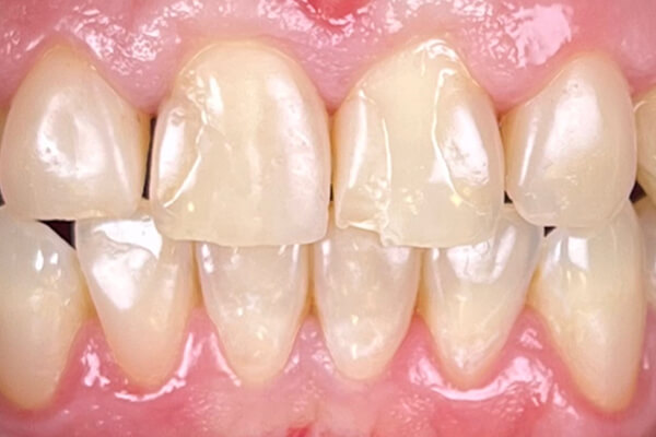 Estetinis 2 — before