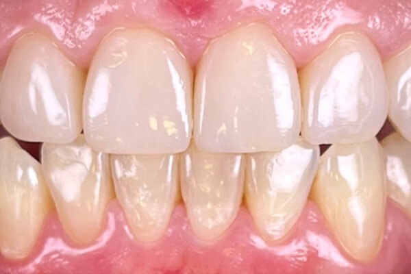 Estetinis 2 — after