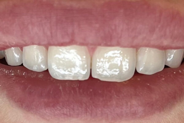 Estetinis 3 — before