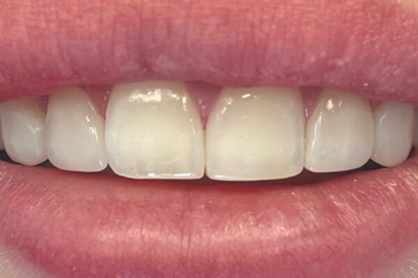 Estetinis 3 — after