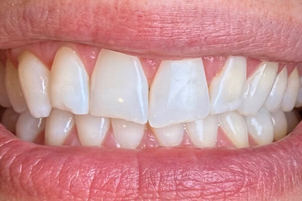 Estetinis 4 — before