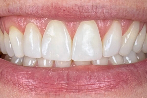 Estetinis 4 — after