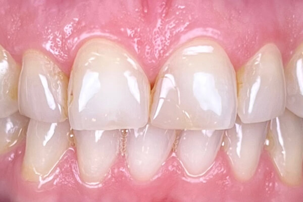 Estetinis 5 — before