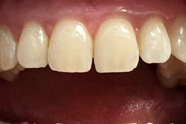 Balinimas 1 — before