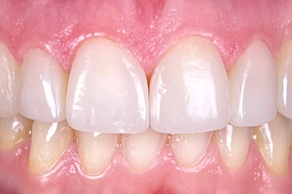 Estetinis 5 — after