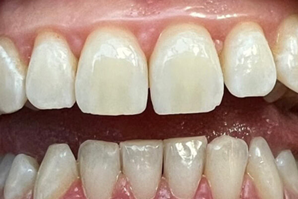 Balinimas 1 — after