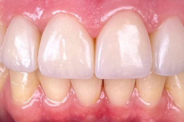 Estetinis 6 — after