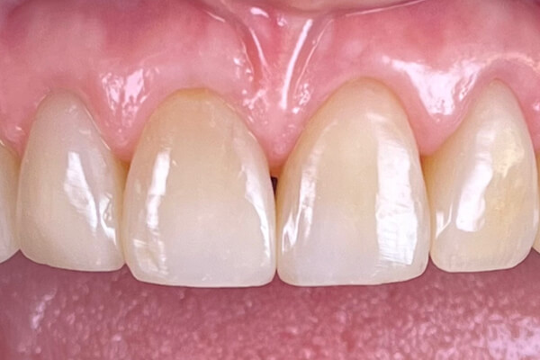 Estetinis 7 — after